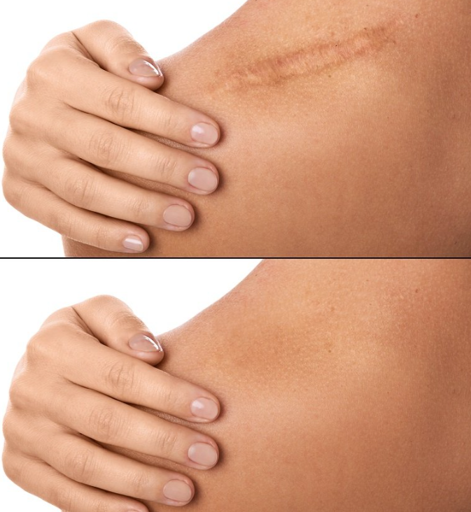 scar removal treatment